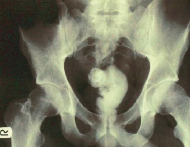 Клизма из эпоксидной смолы с целью сексуальной стимуляции Медицина, Наука, История болезни, Перевел сам, Длиннопост