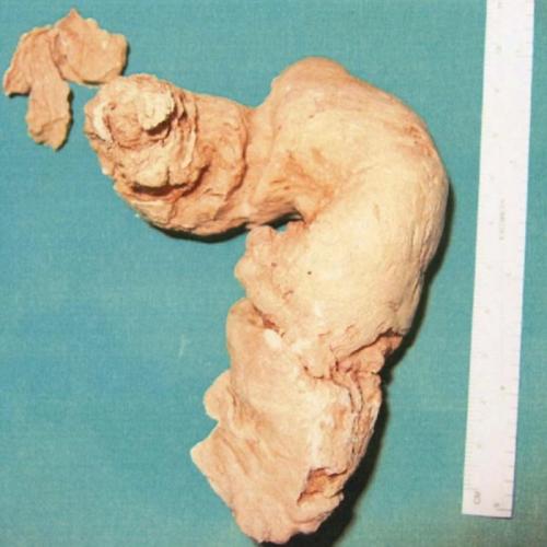 Клизма из эпоксидной смолы с целью сексуальной стимуляции Медицина, Наука, История болезни, Перевел сам, Длиннопост