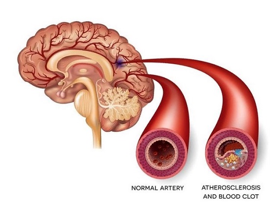 С возрастом происходит естественный износ сосудов головного мозга и снижение упругости их стенок